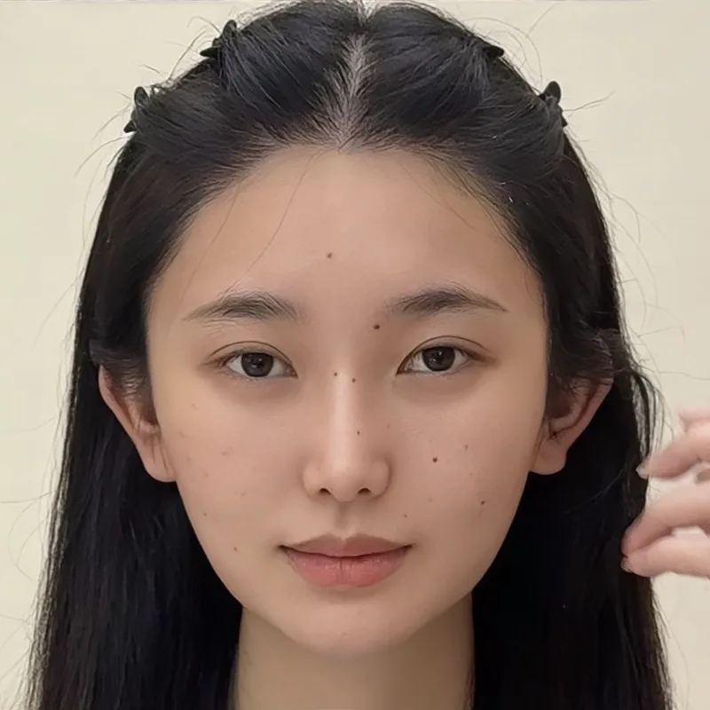 Hairline lowering & framing — female patients — After · Case 1