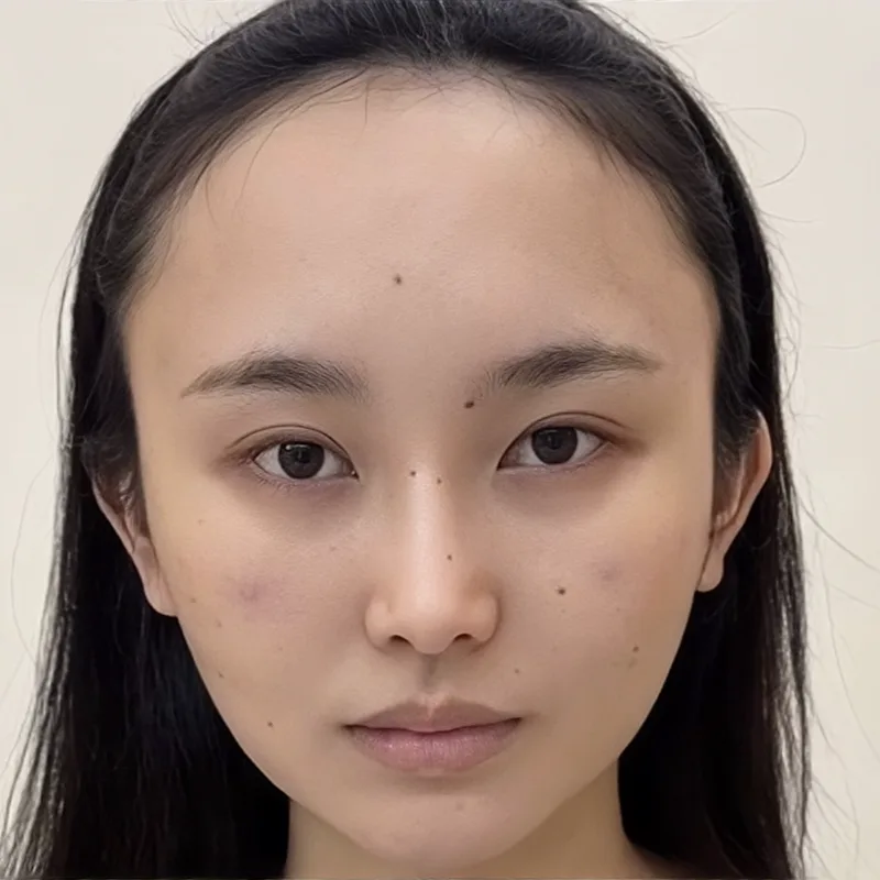 Hairline lowering & framing — female patients — Before · Case 1