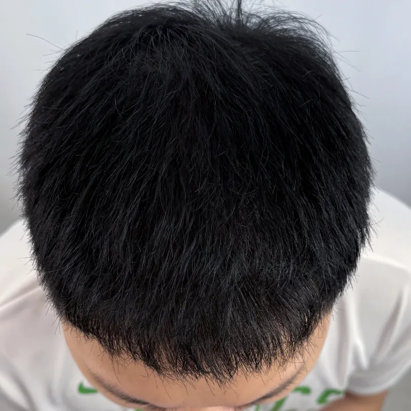 Hairline & density — male patients — After · Case 1