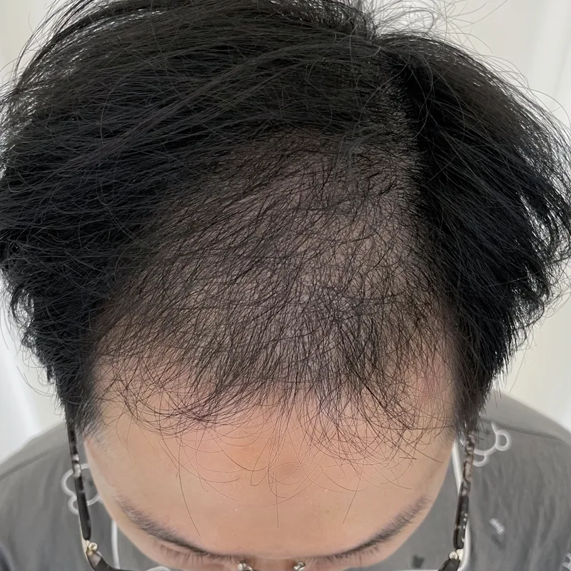 Hairline & density — male patients — Before · Case 1